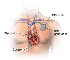 Vista frontal del pecho de un hombre donde se observa un desfibrilador automático implantable.