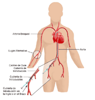 Ilustración de los lugares de cateterismo