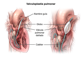 Una vista interior del corazón, que muestra un catéter y el globo.