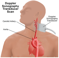 Transductor de ecografía Doppler.