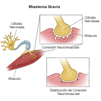 Ilustración de la miastenia grave